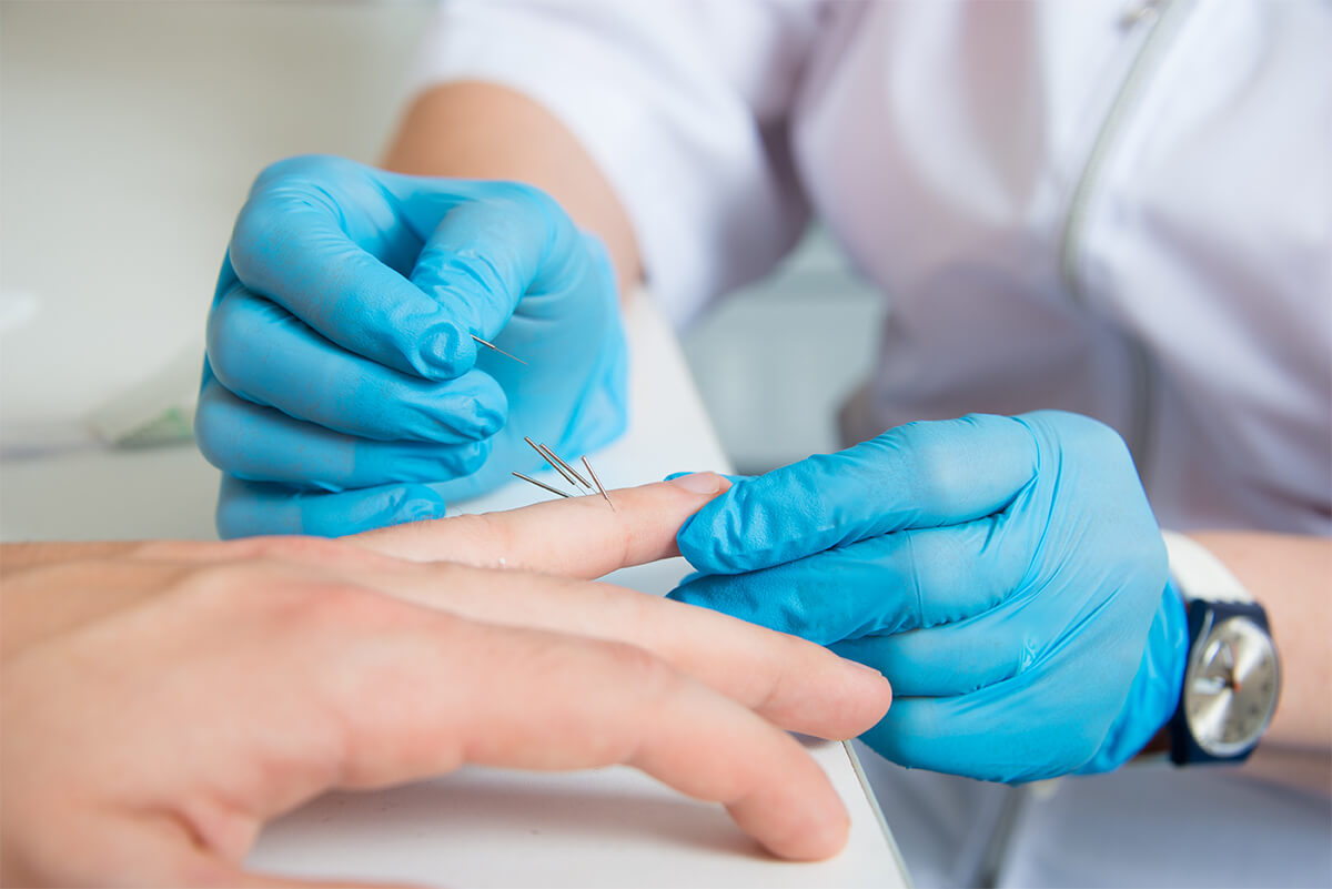 dry needling treatment denver co dry needling treatment denver co